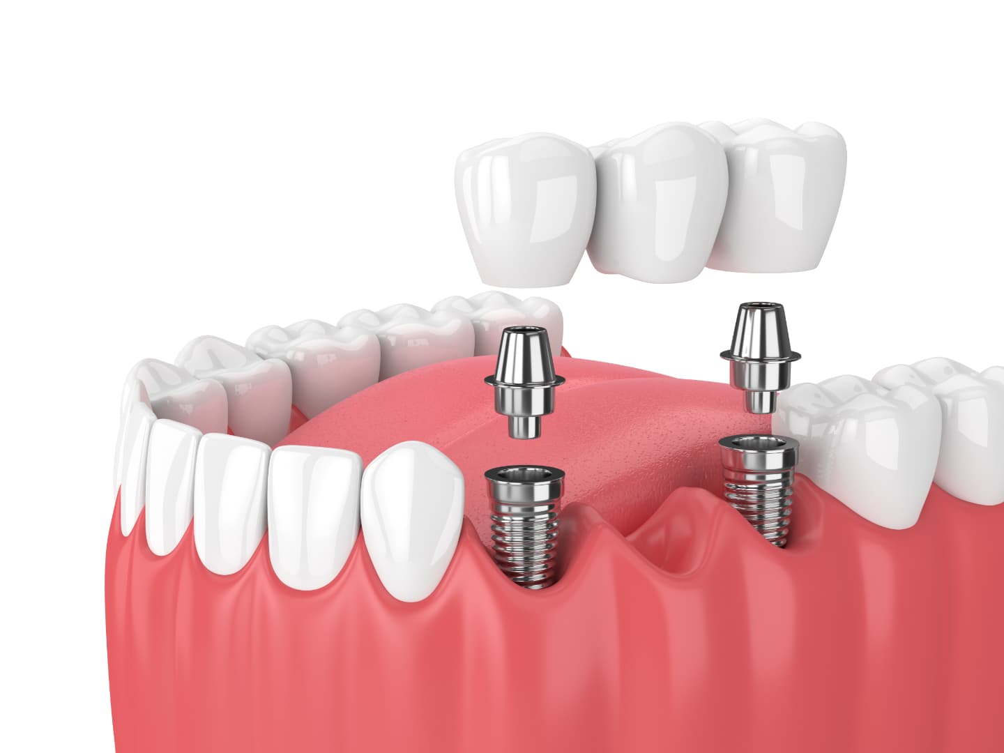 Implants dentaires